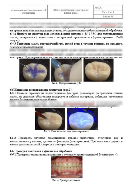 СОП «Неинвазивная герметизация фиссур зуба»